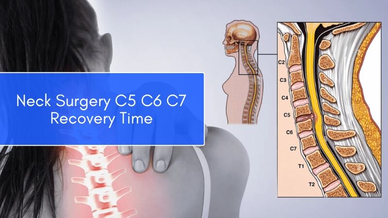 Understanding of Neck Surgery c5 c6 c7 Recovery Time - Best Surgery ...